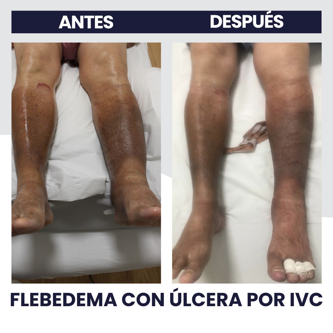6. Flebedema con Ulcera por IVC I