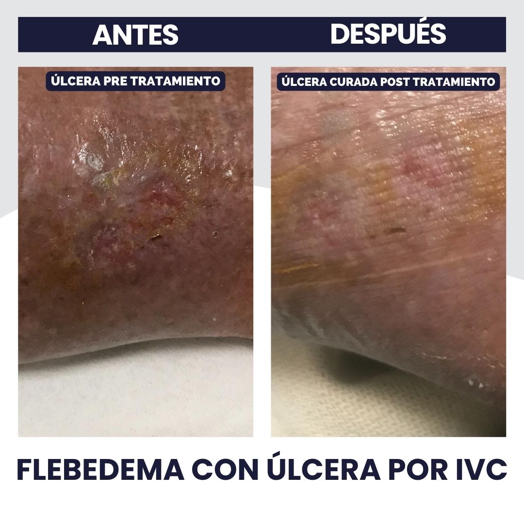 7. Flebedema con Ulcera por IVC II